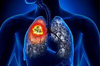 На Кубани с 26 июня по 2 июля проходит Неделя профилактики рака лёгкого